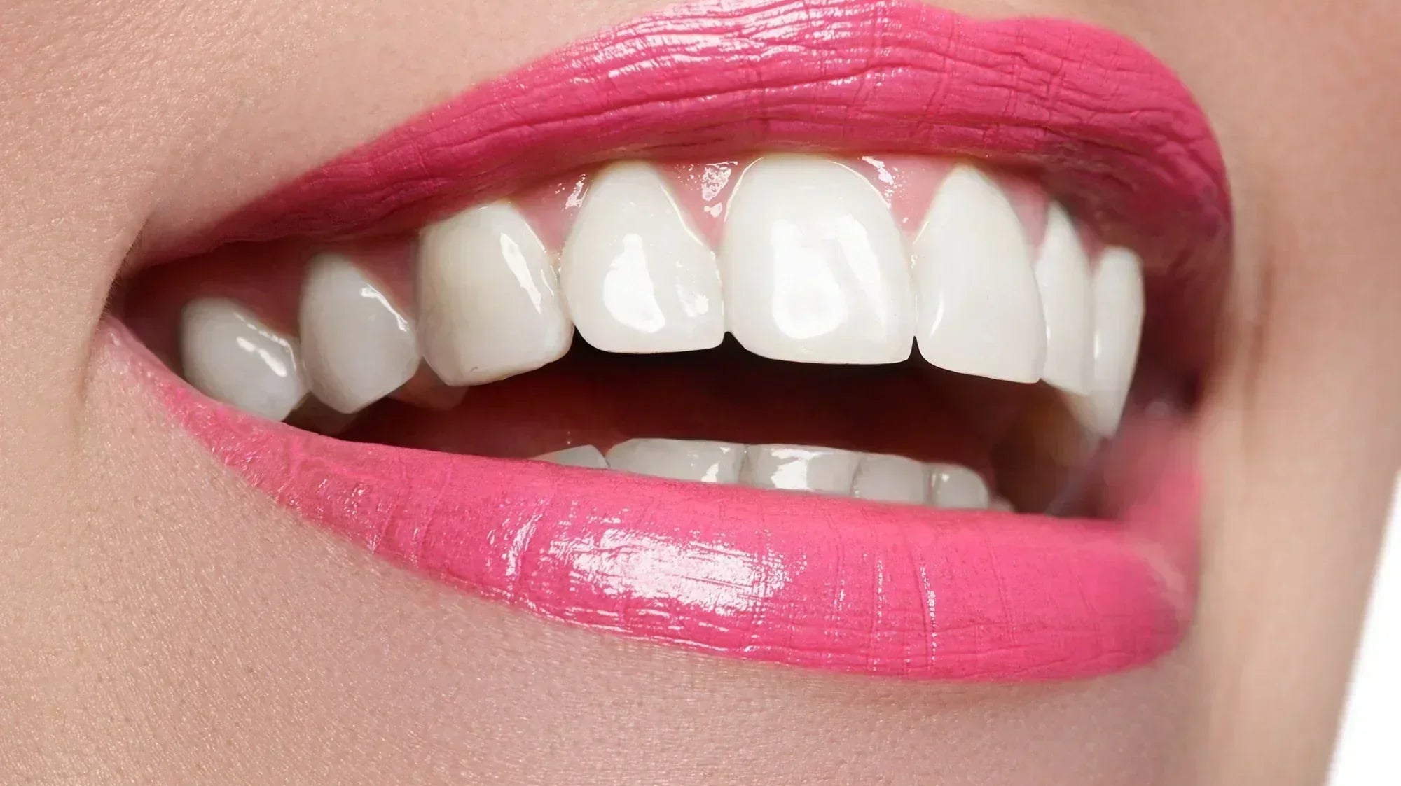 Weisse Zähne nach professioneller Zahnaufhellung