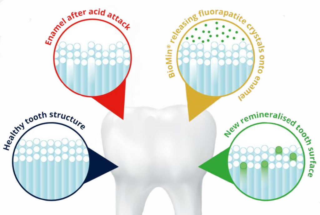 Calcium-Natrium-Fluorophosphosilicat  remineralisiert den Zahnschmelz effektiver als herkömmliche Fluoridzahnpasta