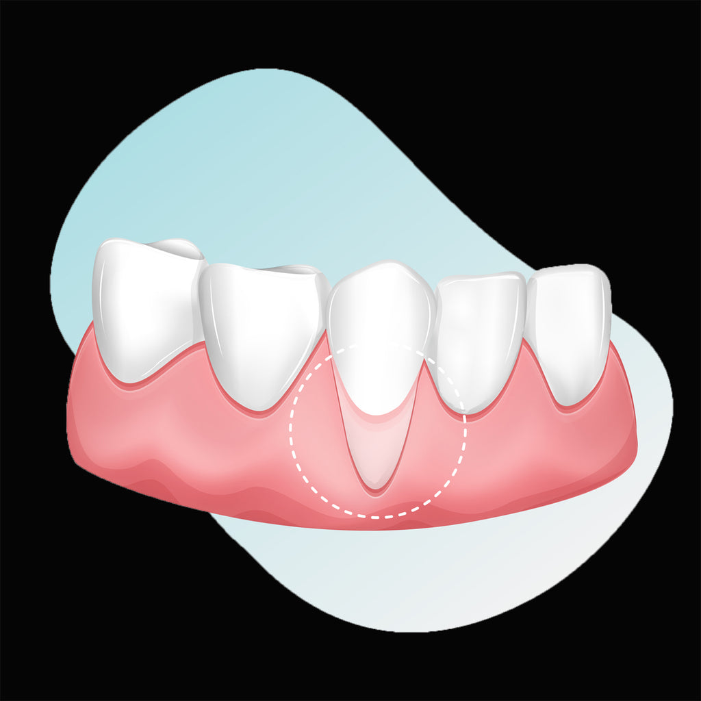 Zahnfleischrückgang: Ursachen, Symptome, Therapie, Prävention