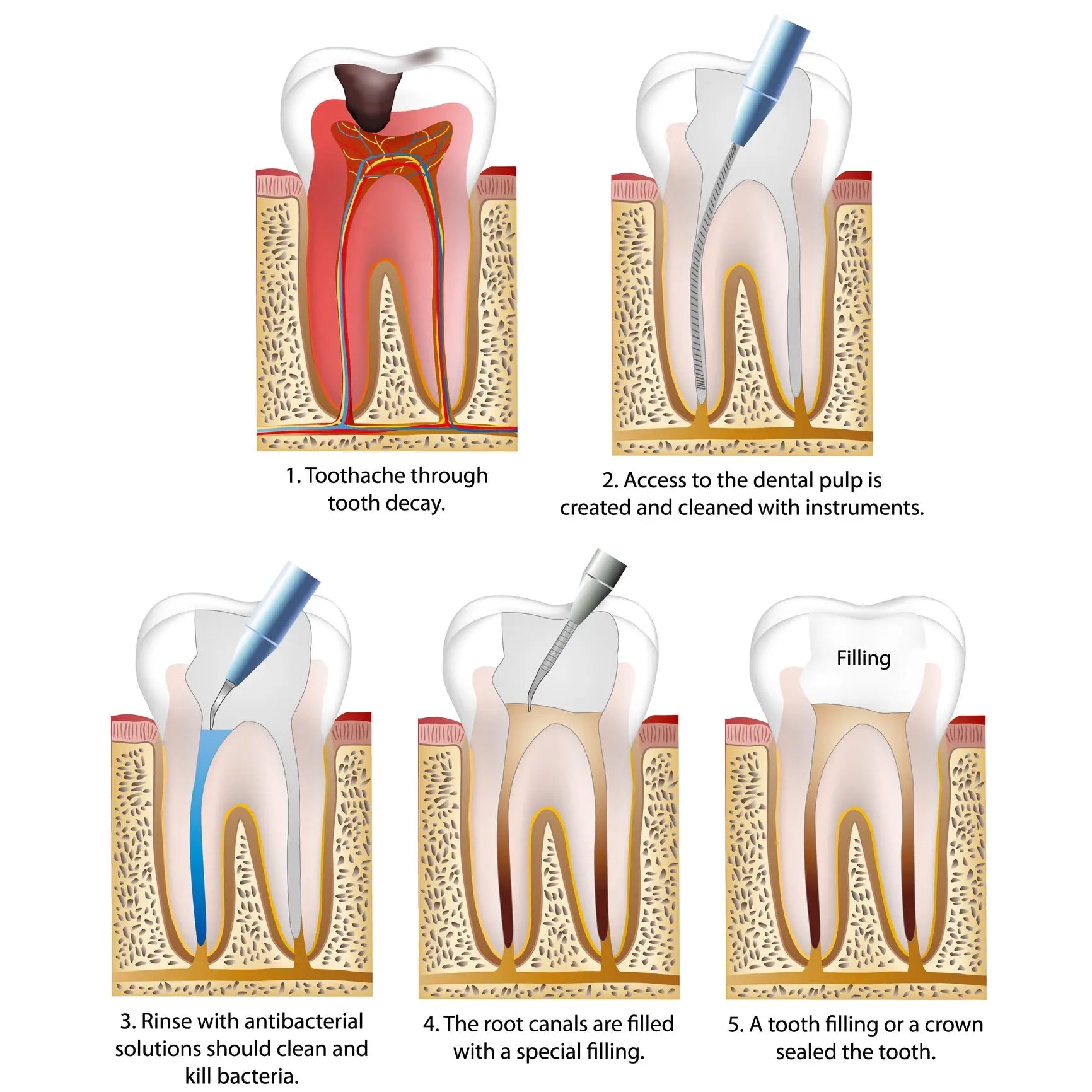 Was-ist-eine-Wurzelbehandlung-und-warum-ist-sie-manchmal-notwendig Snow Pearl GmbH